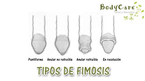 foto fimosis|Imágenes